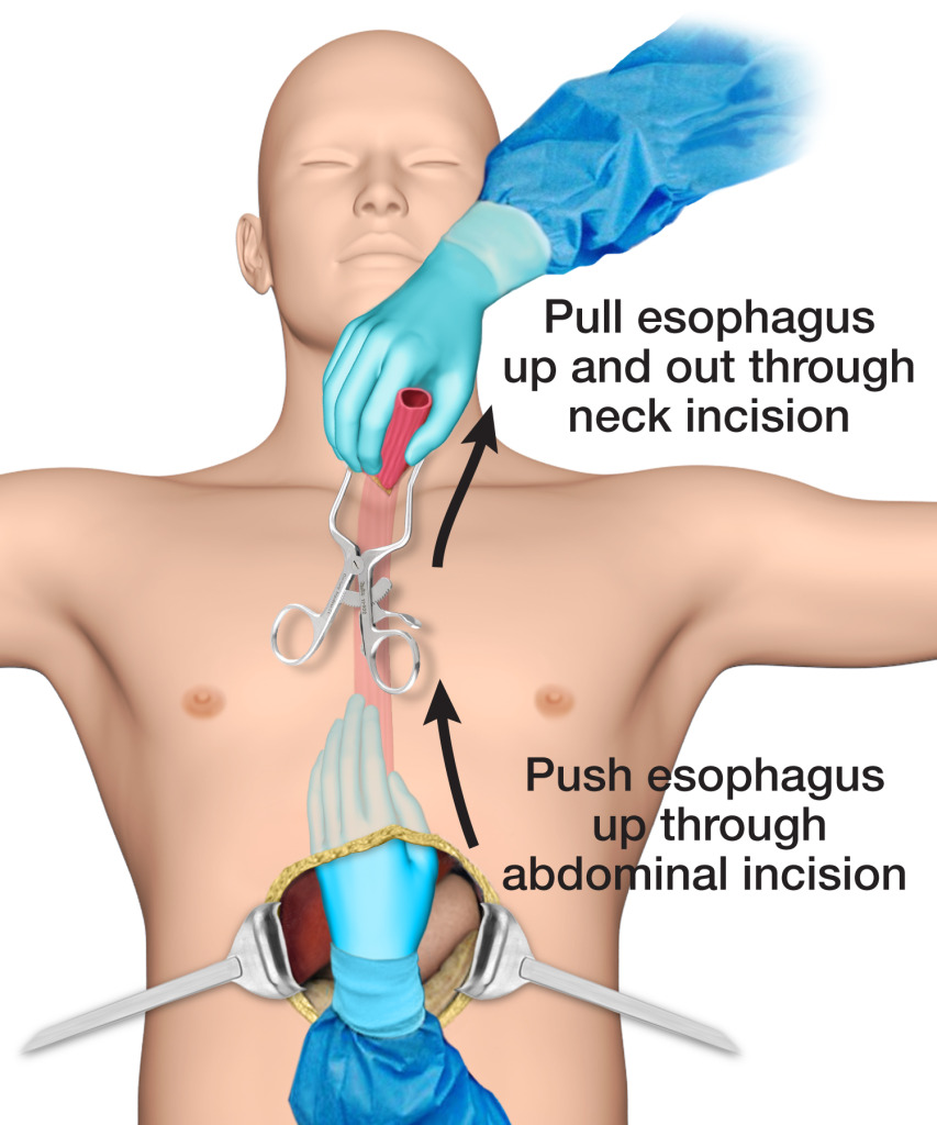 Removal of cancerous esophagus.