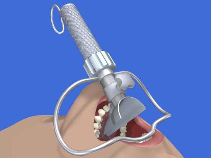 Transoral Retractor in Throat